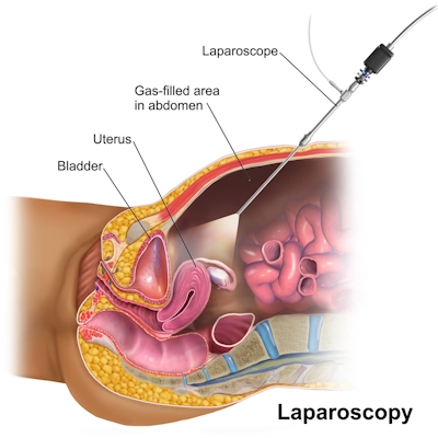 Laparoscopy Keyhole Surgery