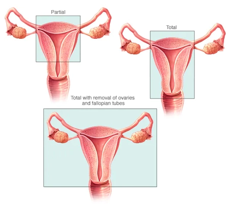 Abdominal Hysterectomy