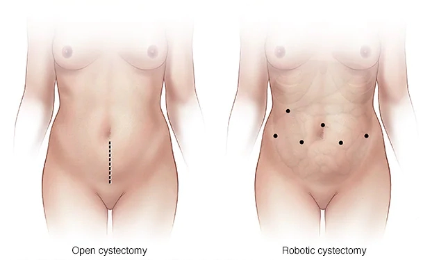 Cystectomy incision sites