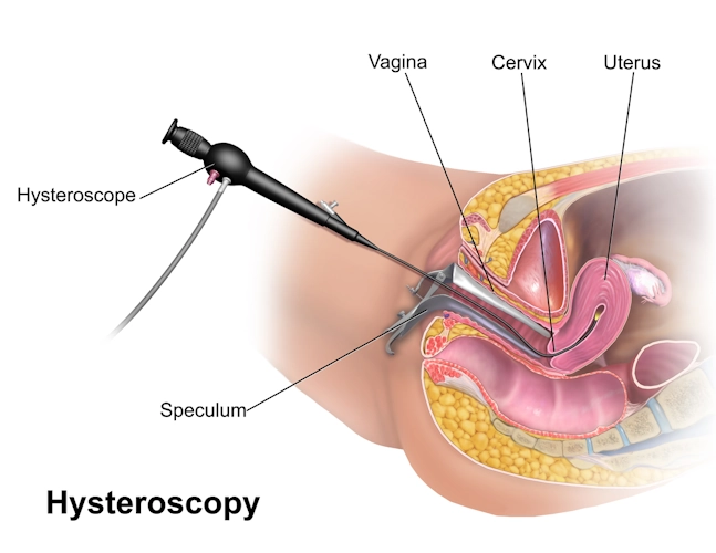 Hysteroscopy