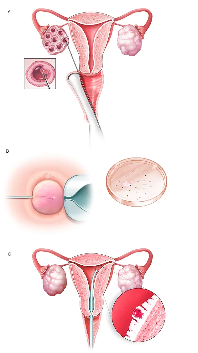 In Vitro Fertilization